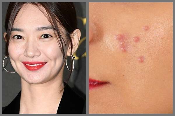 여드름 피부의 모든 것 신민아 여드름