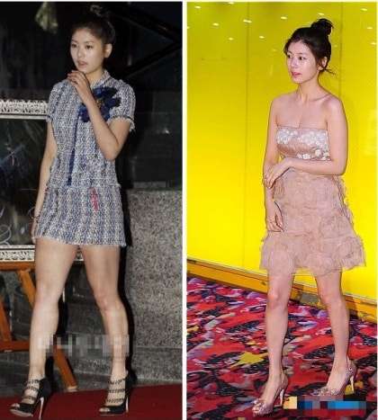 정소민 발목 비포 애프터